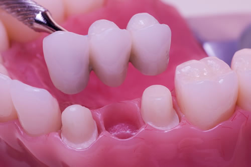 dental-bridge-header