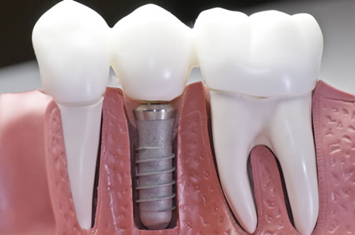 tooth implant