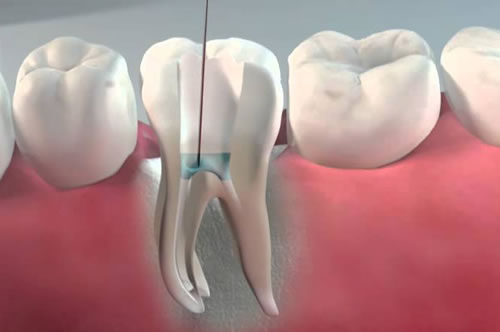 root_canal